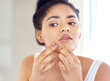 Acabemos con algunos mitos sobre el acné